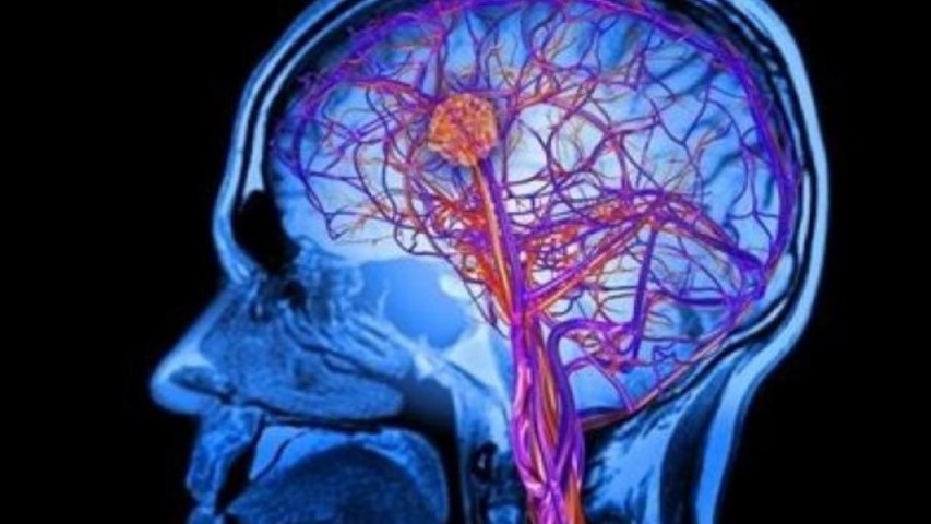 هكذا تتجنب خطر السكتة الدماغية