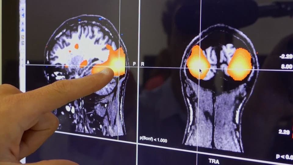 إصابات الدماغ الخفيفة قد تسبب عجزا بوظائف الجسم