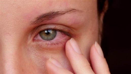 أسباب التهاب العيون وطرق الوقاية