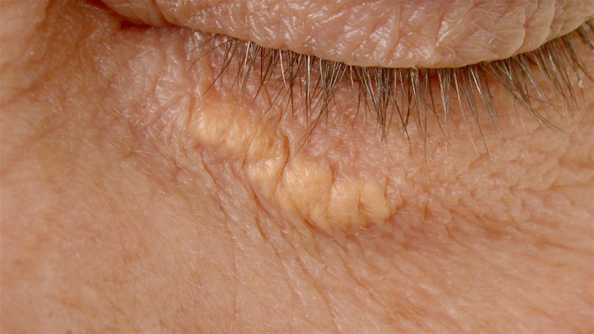 علامة في العين قد ينذر وجودها بخطر الإصابة بنوبة قلبية