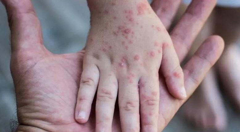 "جدري القردة"وصل الى لبنان!