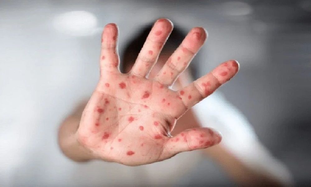 جدري القرود ينتشر في لبنان!